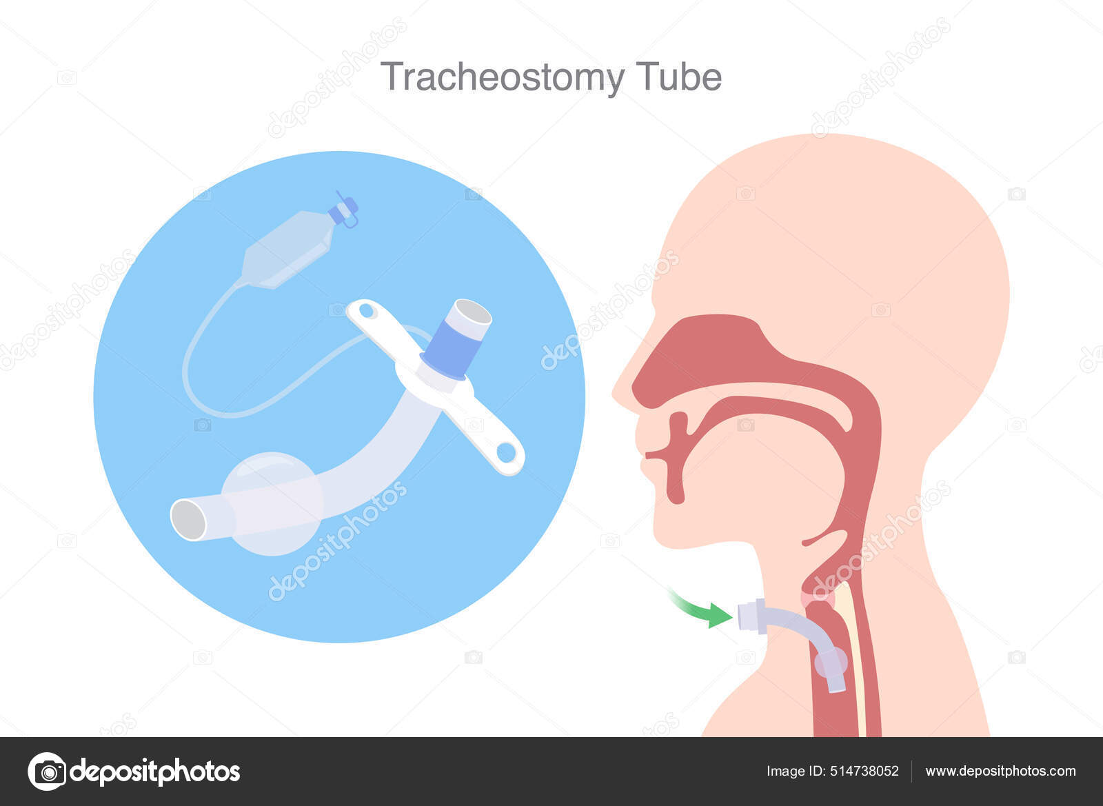 Tube Trachéostomie Est Dispositif Pour Aider Patient Qui Peut Pas image