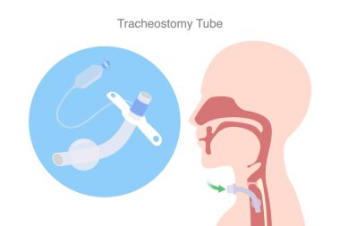 Trakeostomi tüpü, ağzı ve burnu ile nefes alamayan hastalara yardımcı olan bir cihazdır. Nefes borusuna silikonlu tüp sokmak için Tracheostomi cerrahi bir yöntem..