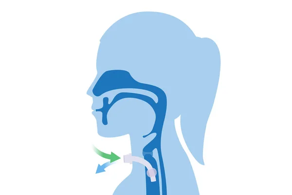 呼吸を助けるために女性の首と気管にシリコンチューブを挿入するための外科的 鼻や口で呼吸できない患者を助けるための医学についてのイラスト — ストックベクタ