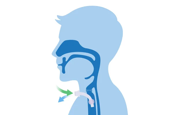Chirurgisch Wird Ein Silikonisierter Schlauch Den Hals Und Die Luftröhre — Stockvektor