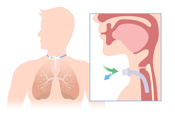 Włożyć Silikonowaną Rurkę Tchawicy Aby Pomóc Oddychaniu Płuca Ilustracja Anatomii — Wektor stockowy