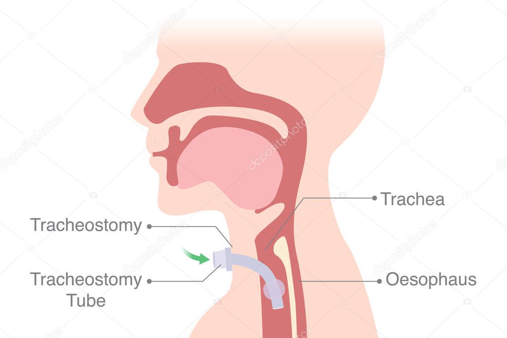 The anatomy of a patient is intubated at the neck into the trachea to help breath. Medical Diagram about Tracheostomy is surgical at the airway system.