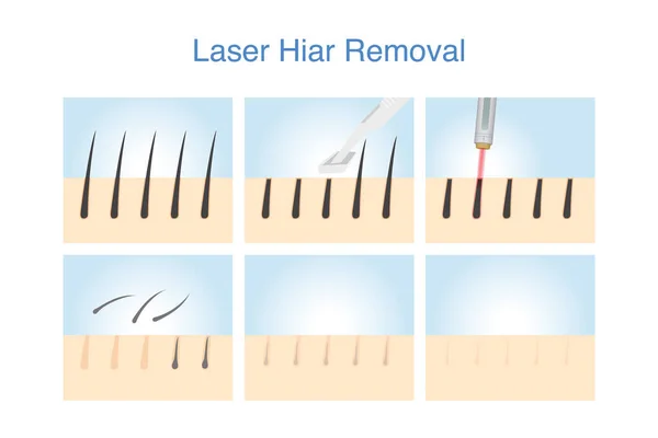 Stape Hair Removal Skin Layer Follicle Shave Laser Illustration Epilation — Stock Vector