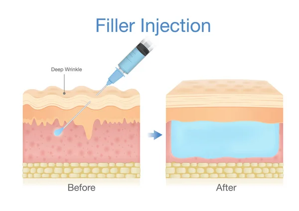 Iniezione Filler Nello Strato Cutaneo Mediante Ago Chirurgia Estetica Illustrazione — Vettoriale Stock