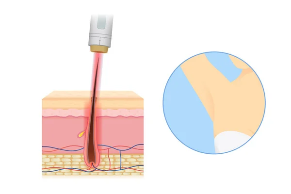 Remoção Cabelo Laser Camada Pele Com Axila Mulher Ilustração Sobre —  Vetores de Stock