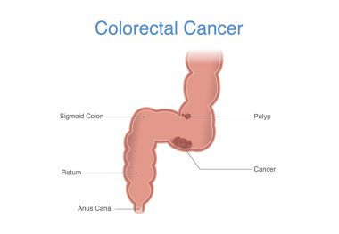 Human Colon or rectum has cancer cells that grow out of control. Colorectal cancer on the passageway that connects the colon to the anus.