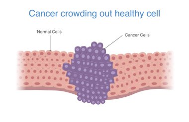 Kanser hücreleri sağlıklı hücreleri doldurur. Tümöre yayılacak kanser metastazı hakkında tıbbi diyagram.