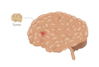 Kanser, tümör olarak gelişen insan beynine yayılır. İnsan iç organında kanser metastazı hakkında tıbbi diyagram.