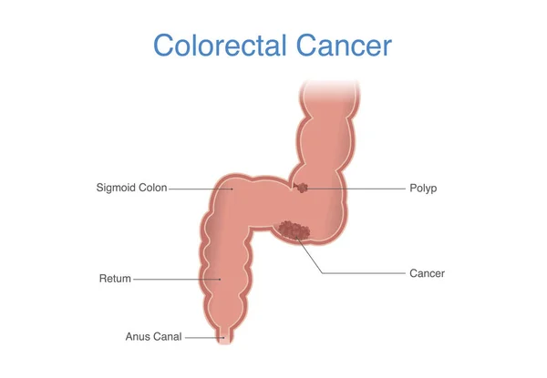 Human Colon Rectum Has Cancer Cells Grow Out Control Colorectal — Vector de stock