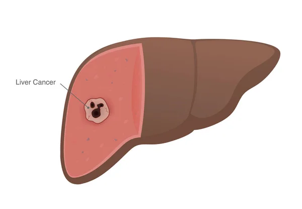 Cancer Propage Foie Humain Qui Développe Être Une Tumeur Diagramme — Image vectorielle