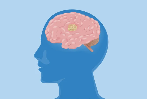 Otak Dalam Siluet Kepala Manusia Memiliki Tumor Diagram Medis Tentang - Stok Vektor