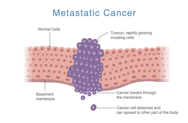 Cancer Propage Une Partie Corps Autres Parties Diagramme Médical Sur — Image vectorielle