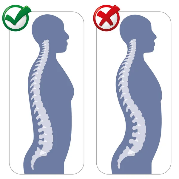 Anatomía Humana Ilustración Hiperlordosis Lumbar Ideal Para Catálogos Boletines Guías — Vector de stock