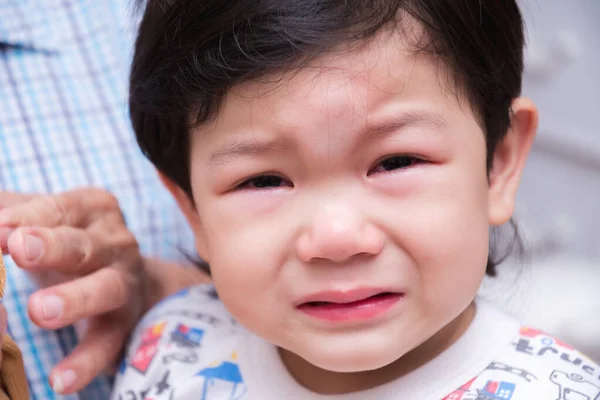 Çocuk Yüzü Darbeden Dolayı Alnında Acıdan Ağlıyordu Kabarık Kafalı Çocuk — Stok fotoğraf