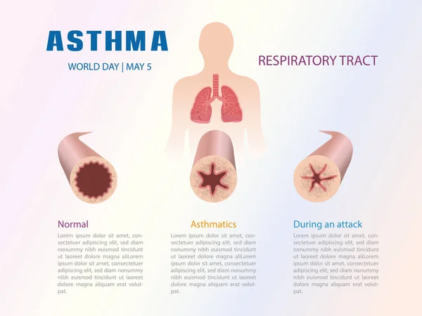 Infografía Del Tracto Respiratorio Proceso Asma — Vector de stock