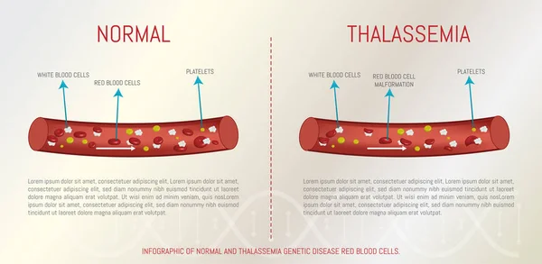 Infographic Της Φυσιολογικής Και Θαλασσαιμίας Γενετική Ασθένεια Ερυθρά Αιμοσφαίρια — Διανυσματικό Αρχείο