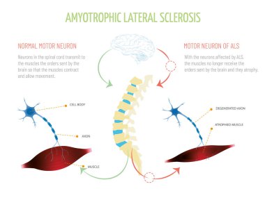 Amiyotrofik lateral sklerozla mücadele için Dünya Günü. Beyaz arkaplanda kas ve nöron 
