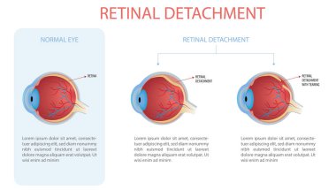 Infographic of a normal eye and an eye with retinal detachment, two types with and without tear. clipart