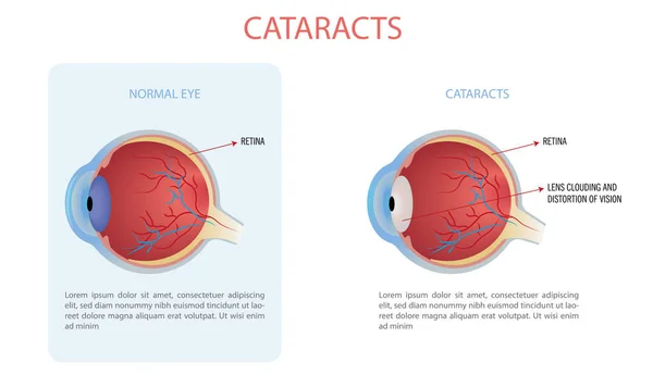 Vector Illustration Cataract Cataract Clouding Lens Eye Causes Loss Vision — Διανυσματικό Αρχείο