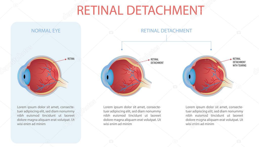 Infographic of a normal eye and an eye with retinal detachment, two types with and without tear.