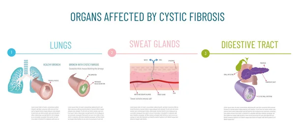 Infographics Main Organs Affected Cystic Fibrosis — Διανυσματικό Αρχείο