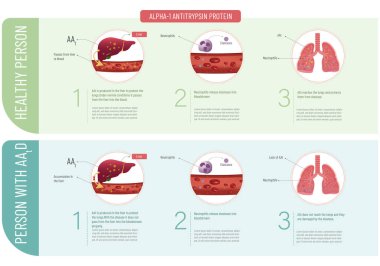 Alfa-1 antitripsin proteini akciğeri korur ve akciğer hastalığına neden olur..