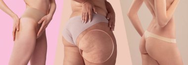 Collage. Cropped image of female buttocks in underwear with smooth and cellulie skin. Anti-cellulite treatment. Taking care after skin. Concept of beauty, body and skin care, health, cosmetics, ad