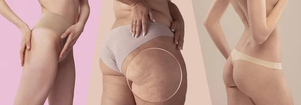 Collage Cropped Image Female Buttocks Underwear Smooth Cellulie Skin Cellulite — Fotografia de Stock