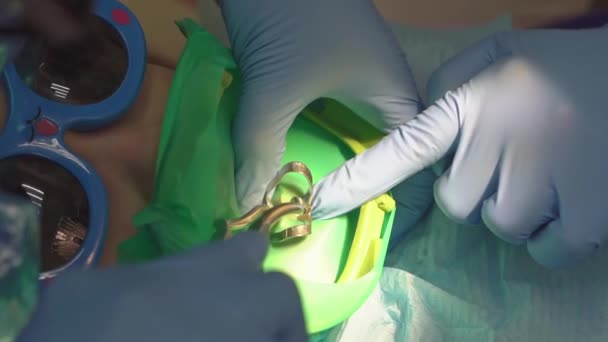 Dentysta wykorzystuje Cofferdam do leczenia próchnicy i rekonstrukcji zębów dziecka — Wideo stockowe