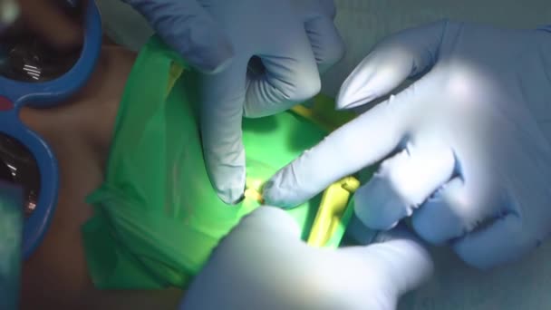 Dentista utiliza Cofferdam para el tratamiento de la caries y la reconstrucción dental de un niño — Vídeo de stock