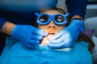 Çocuklar için uygulama anestezisi - jel enjeksiyondan önce sakıza uygulanır