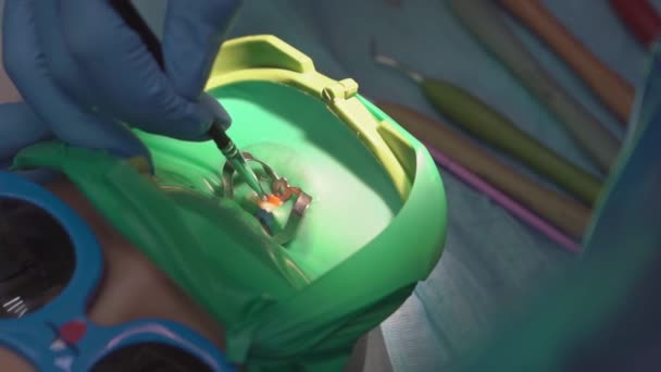 Стоматолог використовує Коффердам для лікування карієсу та відновлення зубів дитини. — стокове відео
