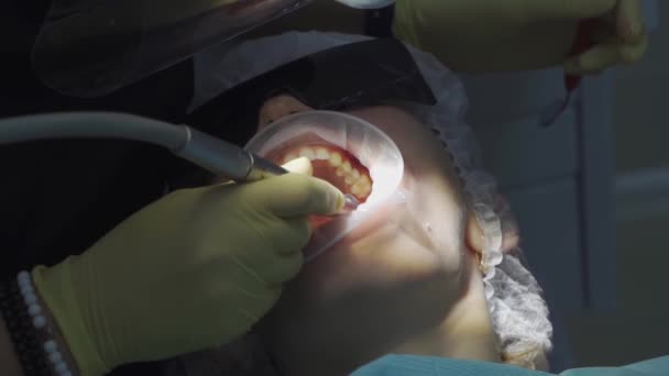 Real. dentista trata al paciente con caries, taladros de dientes e instala relleno — Vídeos de Stock