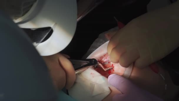 A sério. dentista puxa para fora um dente sabedoria doente. — Vídeo de Stock