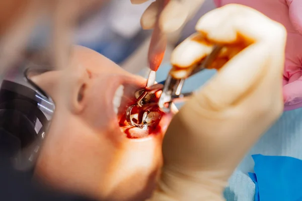 Verkligt. tandläkare drar ut en sjuk visdom tand. — Stockfoto