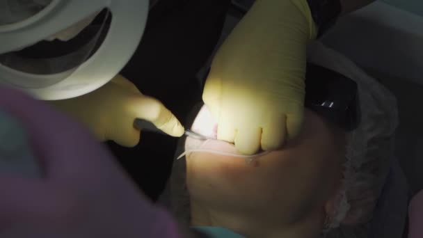 Vero. dentista tira fuori un dente del giudizio malato. — Video Stock