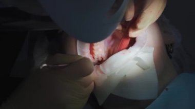 Gerçek. Dişçi hasta bir yirmilik dişi çıkardı.. 