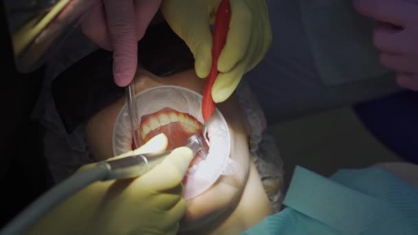 Réel. dentiste traite le patient avec des caries, perce la dent et installe le remplissage — Video