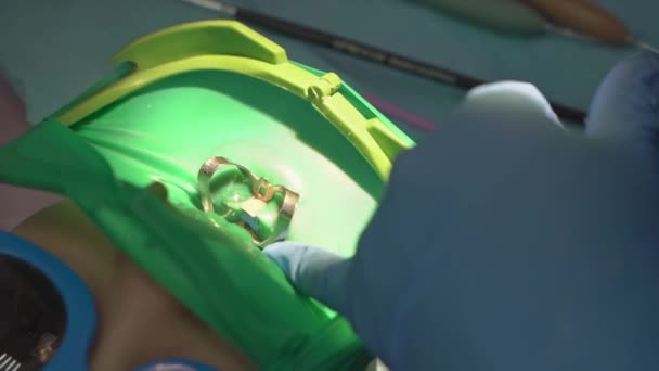 Tandarts gebruikt Cofferdam voor de behandeling van cariës en tandreconstructie van een kind — Stockvideo