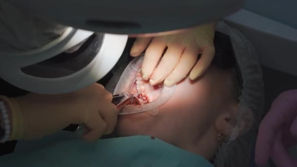 Real. dentista saca una muela del juicio enfermo. — Vídeos de Stock