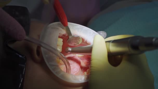 Справжній. стоматолог лікує хворого карієсом, свердлить зуб і встановлює пломбу — стокове відео