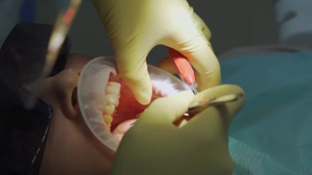 Gerçek. Diş hekimi hastaya bakıcı, diş matkabı ve dolgu malzemesi veriyor. — Stok video