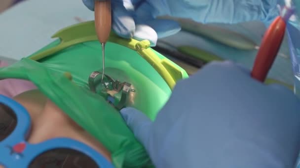 Dentista utiliza Cofferdam para el tratamiento de la caries y la reconstrucción dental de un niño — Vídeo de stock