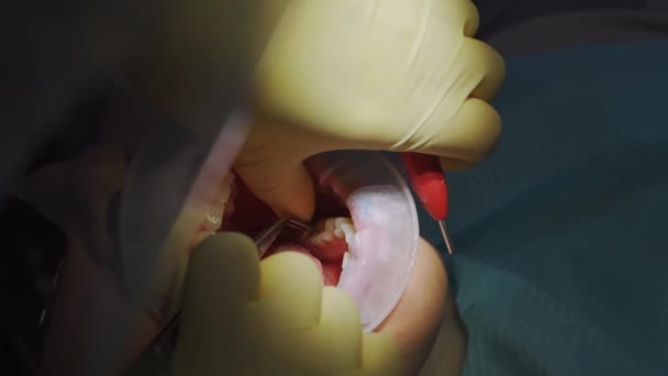 A sério. dentista trata paciente com cárie, broca dente e instala enchimento — Vídeo de Stock