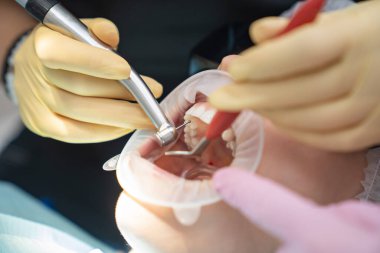 Gerçek. Diş hekimi hastaya bakıcı, diş matkabı ve dolgu malzemesi veriyor.