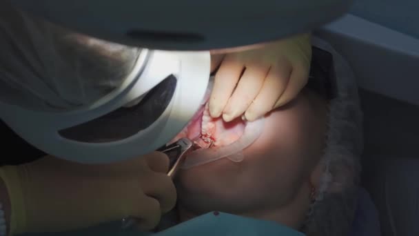 Справжній. стоматолог витягує зуб хворої мудрості . — стокове відео