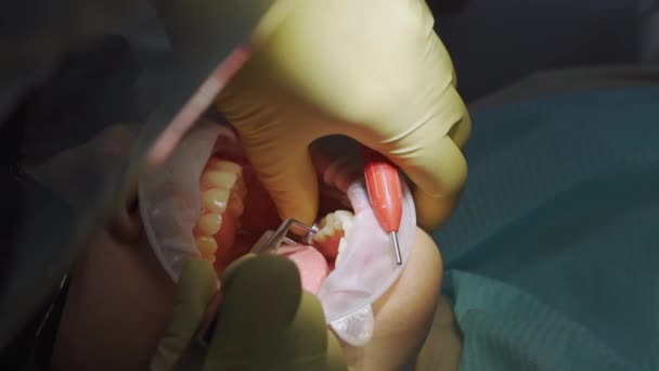 真实的。牙科医生用龋、钻牙和填充物治疗病人 — 图库视频影像