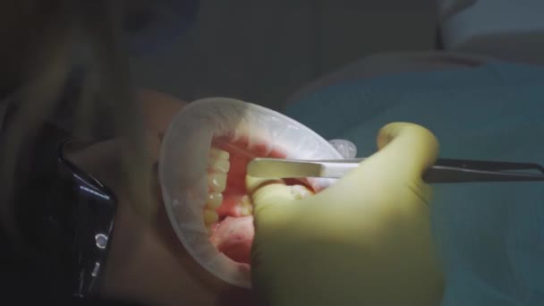 Verkligt. tandläkare behandlar patienten med karies, borrar tand och installerar fyllning — Stockvideo