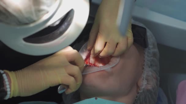 Real. dentista saca una muela del juicio enfermo. — Vídeo de stock