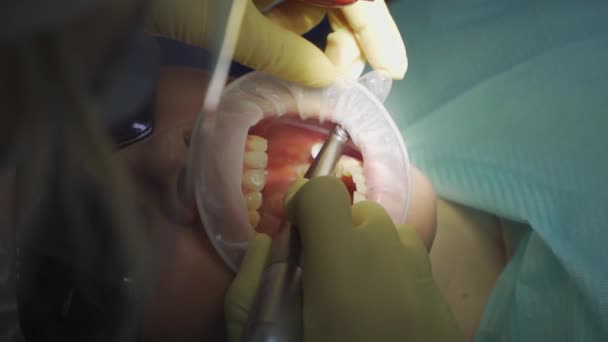Vero. dentista cura il paziente con carie, trapani dente e installa riempimento — Video Stock